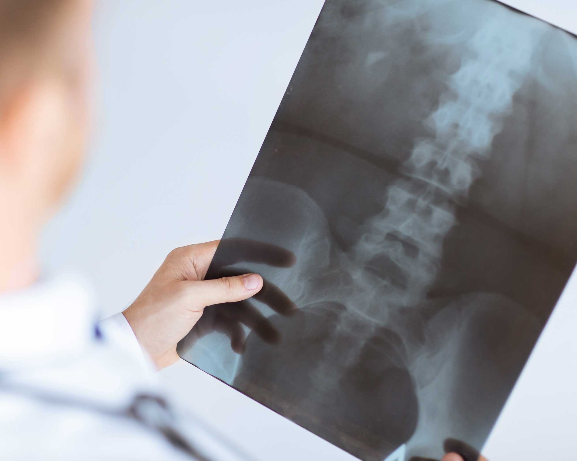 Doctor examining a spine X-ray
