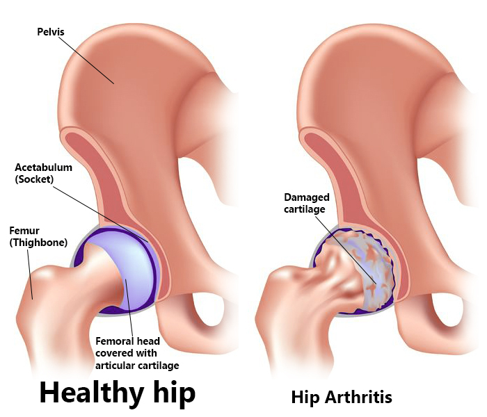 Healthy vs arthritic hip