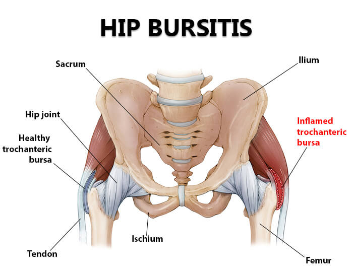 Hip bursitis anatomy