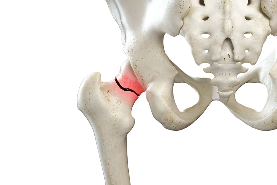 Hip fracture