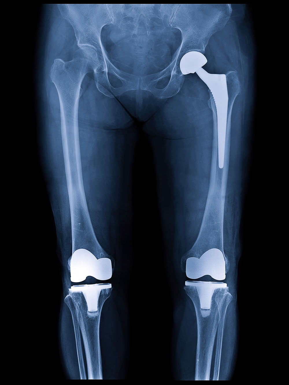 Hip and knee arthroplasty