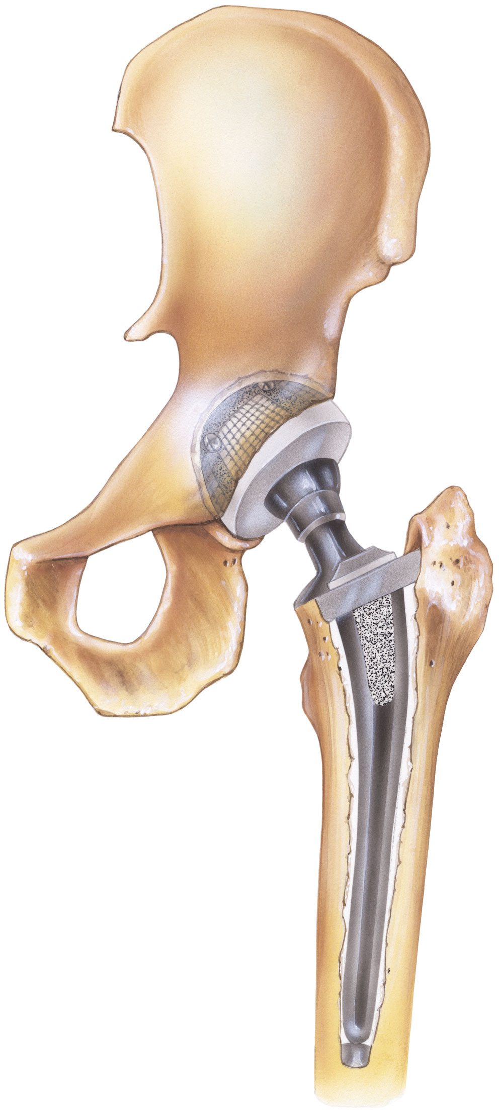 Total hip replacement diagram